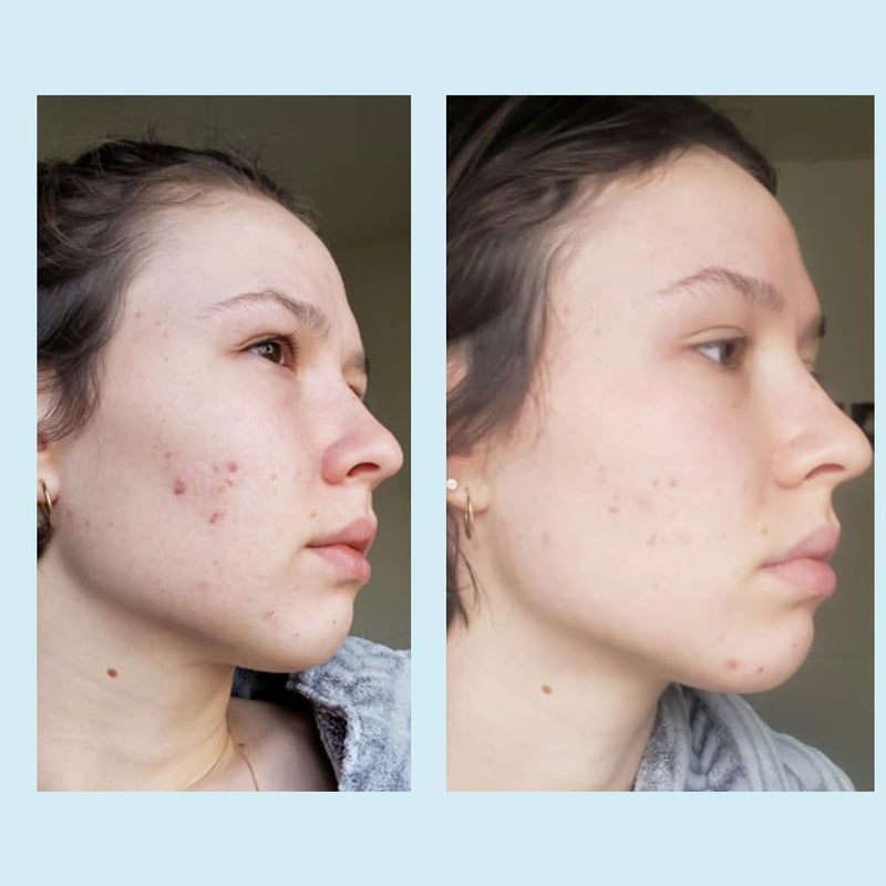 PERFECT IMAGE Glycolic Acid 50% Gel Peel - Enhanced with Retinol & Green Tea Extract (Professional Skin Peel)1 ounce - Image 4